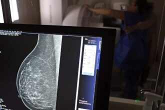 Mamografia digital para diagnóstico do câncer de mama