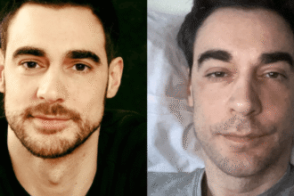Ator francês teve complicações de uma cirurgia de hernia