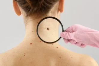 Estudo alerta para melanoma fora da pele e acesso desigual no SUS