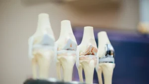 Pesquisa encontra partículas metálicas de próteses no cérebro humano