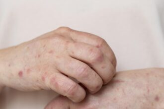 Vacinação contra o sarampo em criança