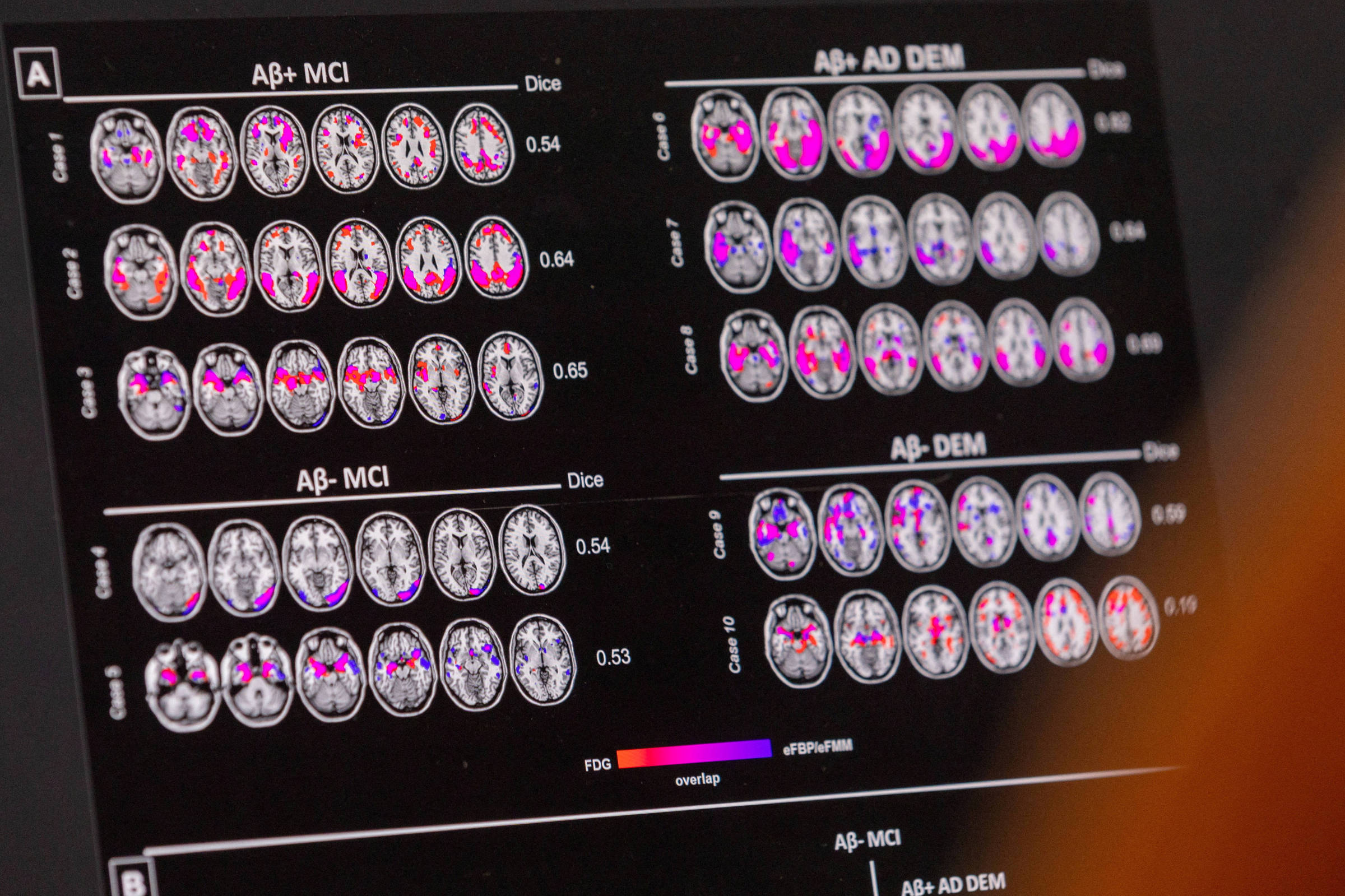 Mudanças de hábitos ajudam até quem tem risco genético de Alzheimer; entenda